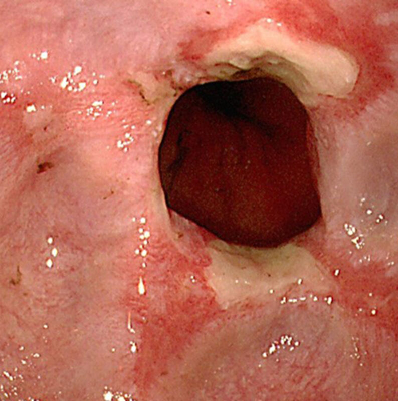 reflux-esophagitis1
